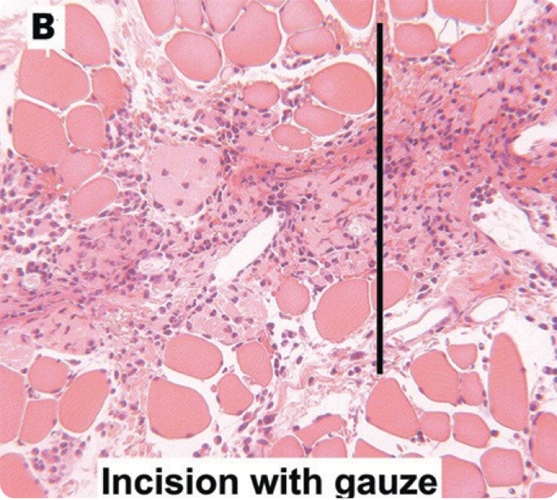 Obraz histologiczny — nacięcie zaopatrzone gazą, nasilony rozproszony stan zapalny