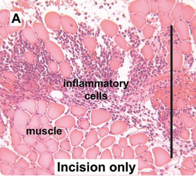 Obraz histologiczny — samo nacięcie, rozproszone komórki zapalne wokół mięśnia
